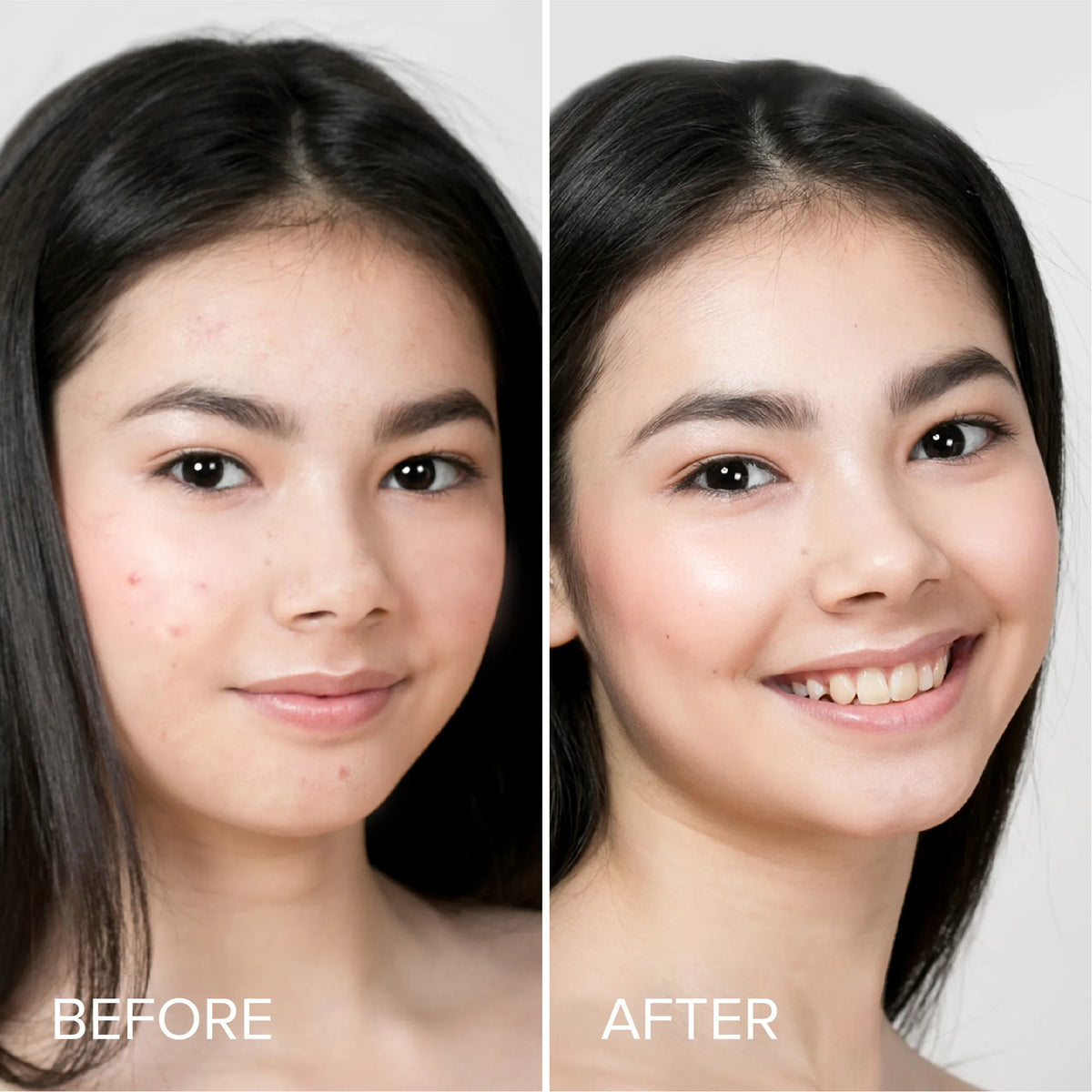 Pimple & Acne Patches – Clear Skin Overnight